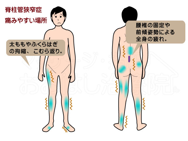 脊柱管狭窄症の症状